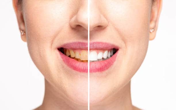 Teeth Whitening Milton Keynes Bedford