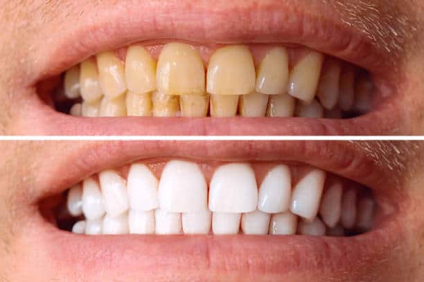 Laser White For Ever Bright – Get a Brighter, Whiter Smile with LA Teeth Whitening Bedford