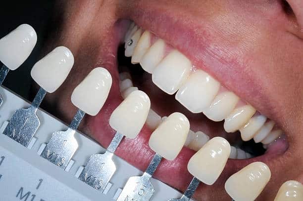 Get Natural and Stunning Smile with Teeth Whitening Results from LA Teeth Whitening Bedford