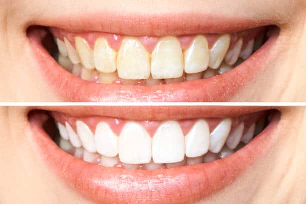 Achieve a Dazzling Smile for Your Special Day: A Guide to Wedding Teeth Whitening Bedford