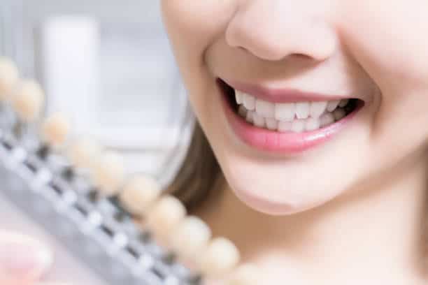 Teeth Whitening Kings Norton Bedford