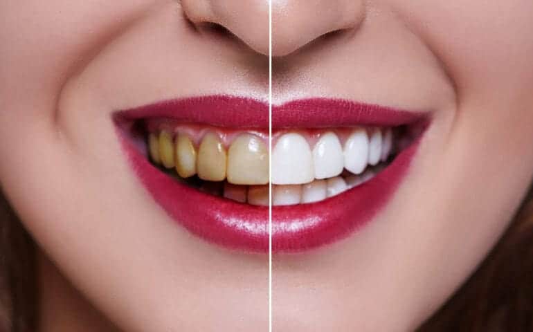 Teeth Whitening Ascot Windsor Bedford