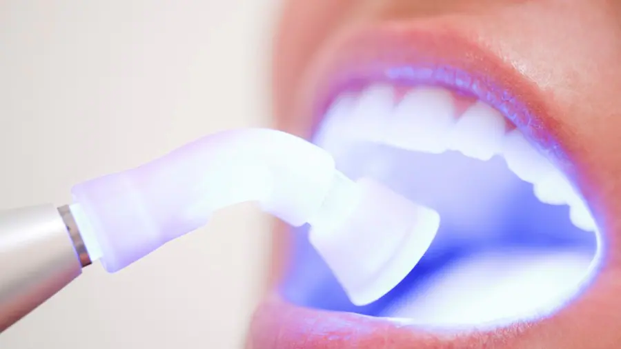 Teeth Whitening Aylesbury Bedford