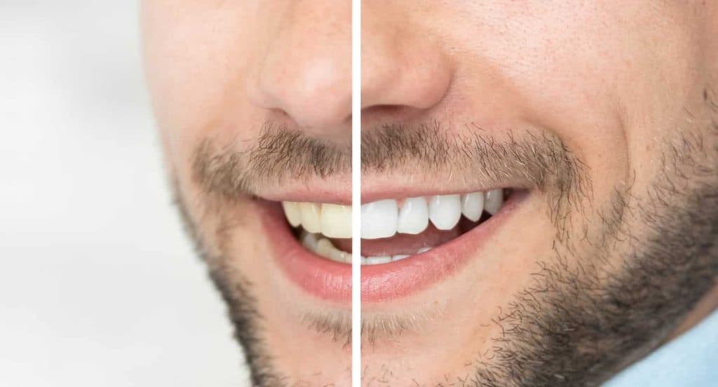 Teeth Whitening Bedfordshire Bedford