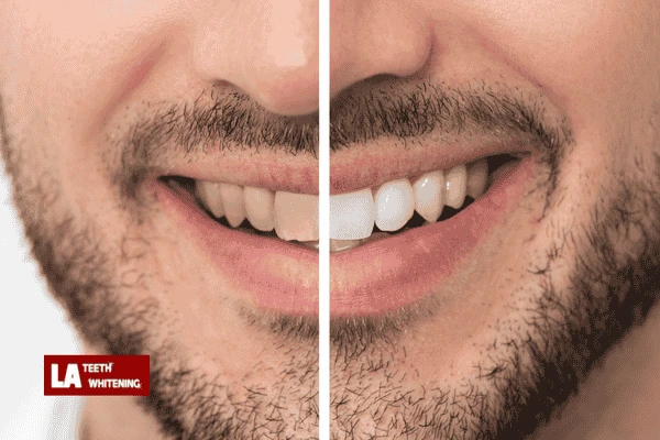 Does laser teeth whitening cause sensitivity? Bedford